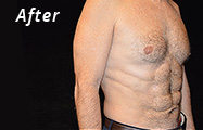 Abdominal Etching After Plastic Surgery Photo Maryland