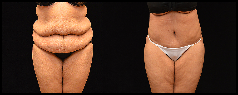 Lower Body Lift Before and After Photos Baltimore - Plastic Surgery Gallery  Columbia - Dr. Daniel Markmann