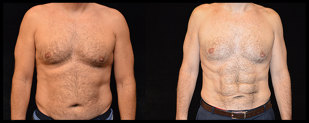 Liposuction - Abdominal Etching & Sculpting Before and After
