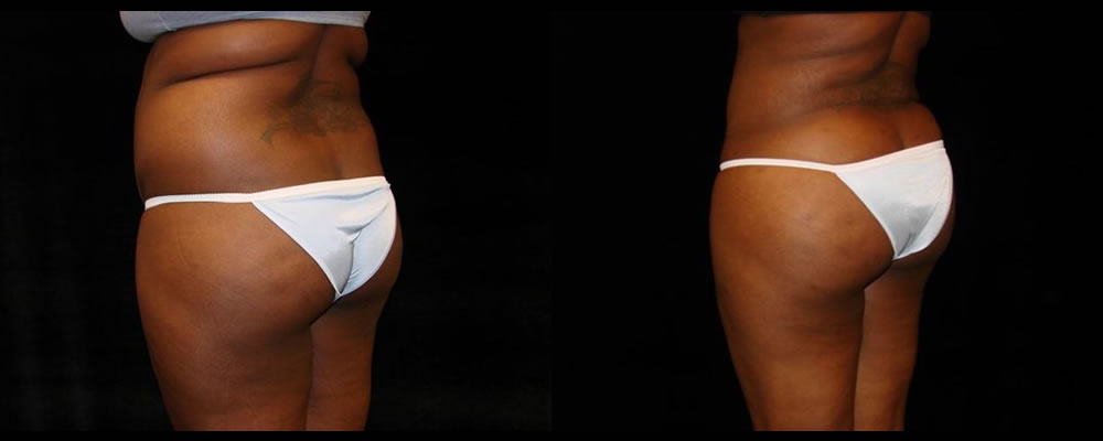 Tummy Tuck Before and After Photos Baltimore - Plastic Surgery Gallery  Columbia - Dr. Daniel Markmann