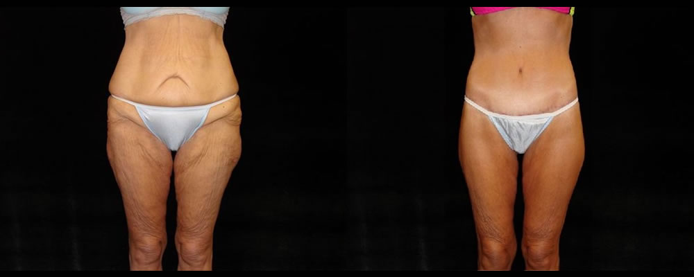 Lower Body Lift Before & After Patient 134, NYC