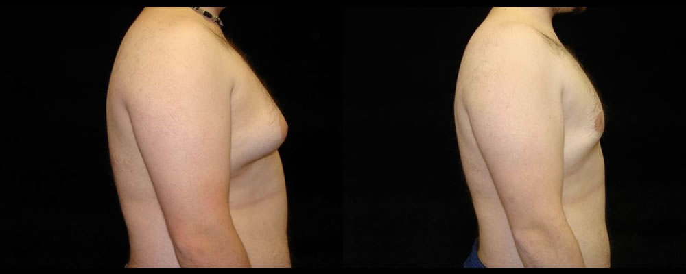 Liposuction Before & After Patient #335