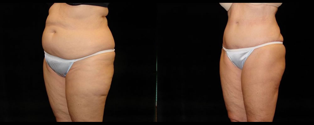 Tummy Tuck Before & After Patient #527