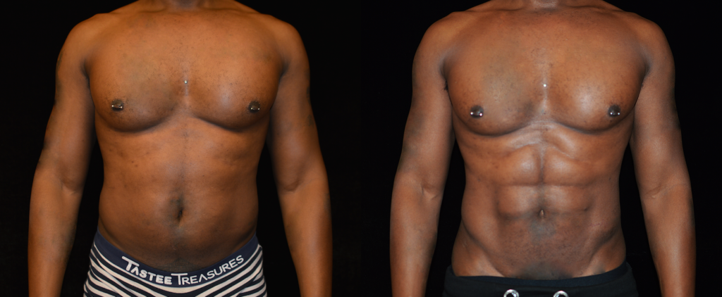 Liposuction - Abdominal Etching & Sculpting Before and After