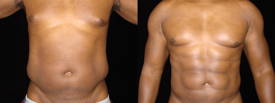 Tummy Tuck Before and After Photos Baltimore - Plastic Surgery Gallery  Columbia - Dr. Daniel Markmann