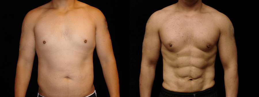 Six Pack Abs Before and After Photos Baltimore - Plastic Surgery