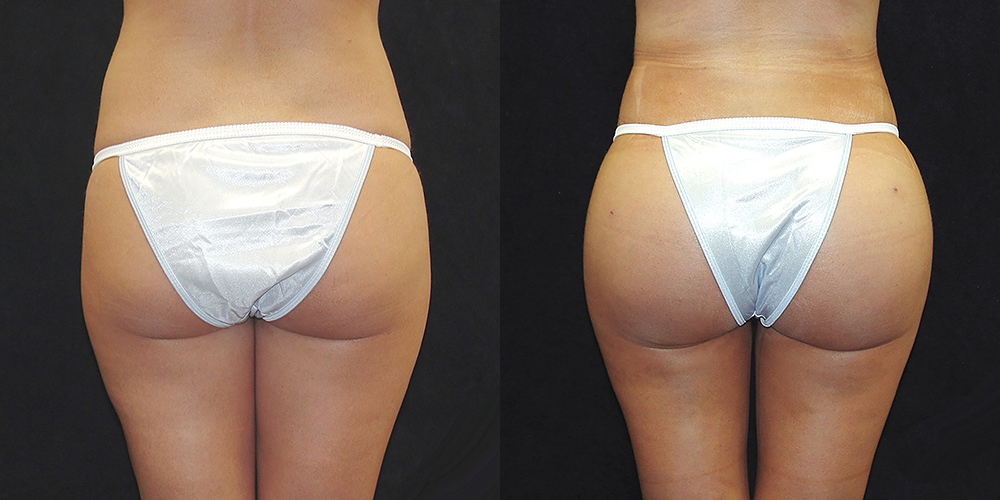 Post-Surgery Guide for Recovering from a Brazilian Butt Lift - The Marena  Group, LLC