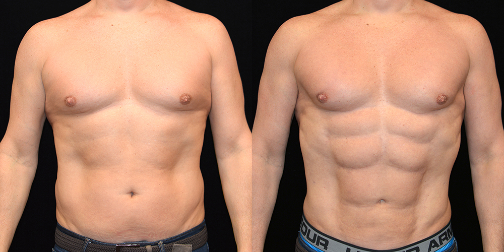 Patient #2763 Six Pack Abs Before and After Photos Baltimore