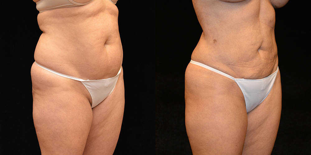 Liposuction Before and After Photos Baltimore - Plastic Surgery