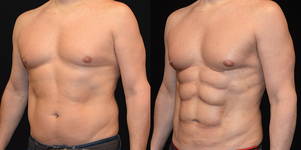 Six Pack Abs Before and After Photos Baltimore - Plastic Surgery Gallery  Columbia - Dr. Daniel Markmann