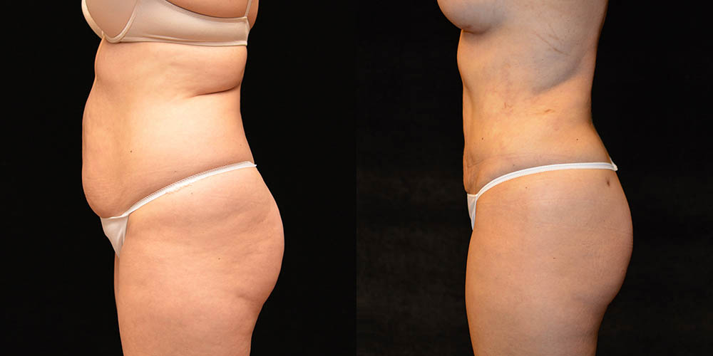 Before & After Tummy tuck with lipo to flanks and thighs - Dr