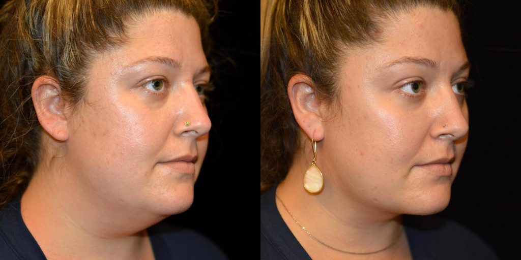 Chin Liposuction Before & After Patient #3461