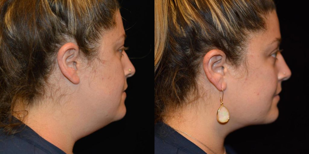 Chin Liposuction Before & After Patient #3461