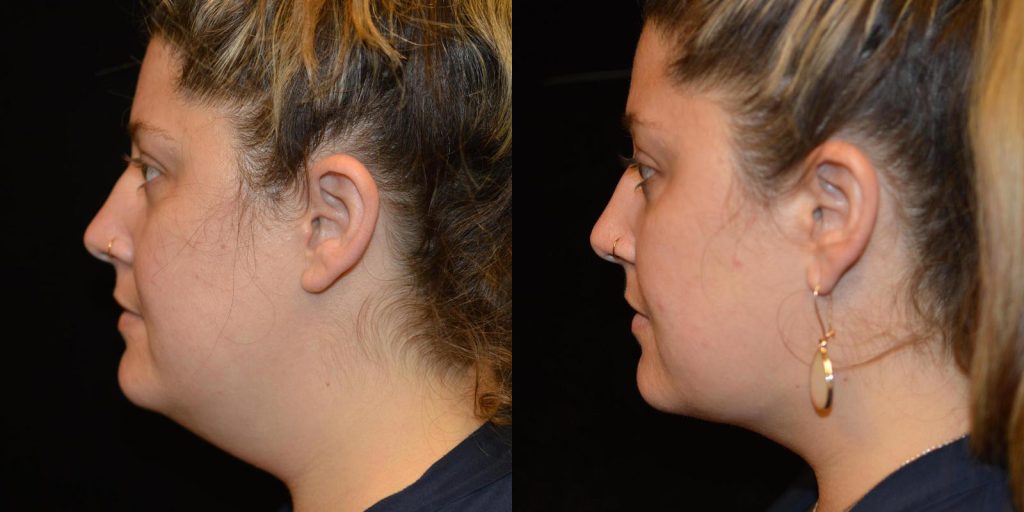 Chin Liposuction Before & After Patient #3461