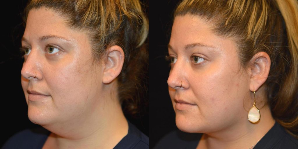 Chin Liposuction Before & After Patient #3461