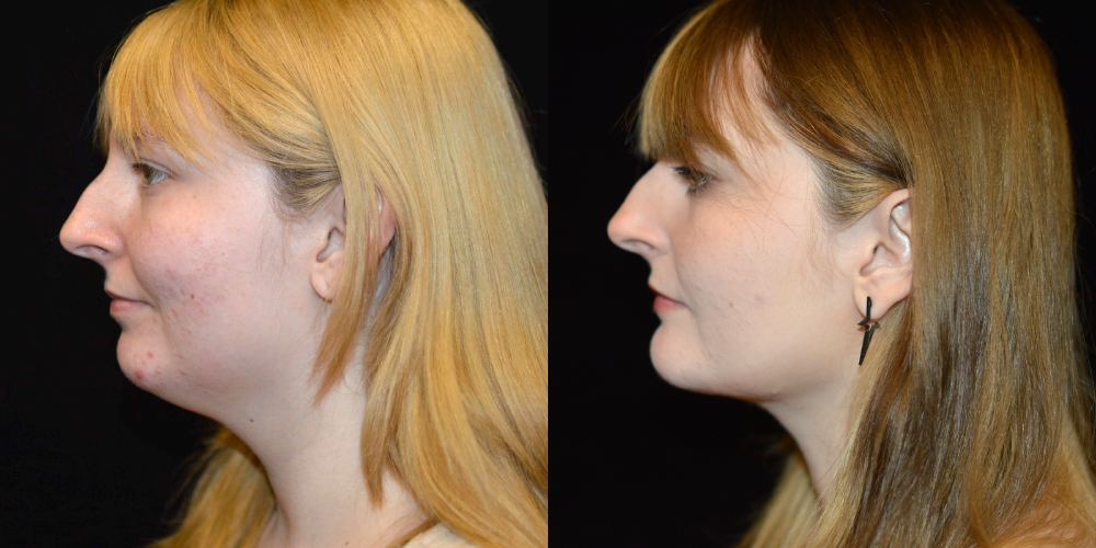 Neck Liposuction Before & After Patient #3611