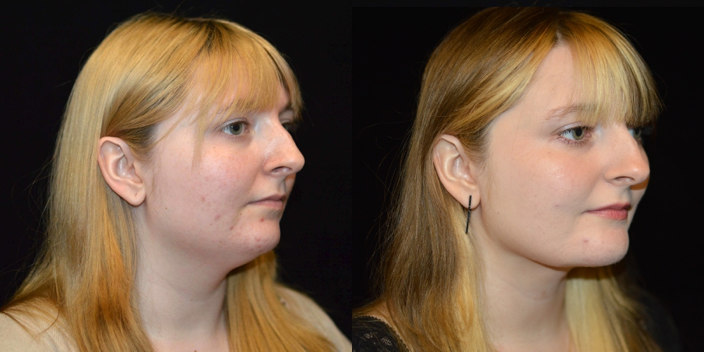 Neck Liposuction Before & After Patient #3611