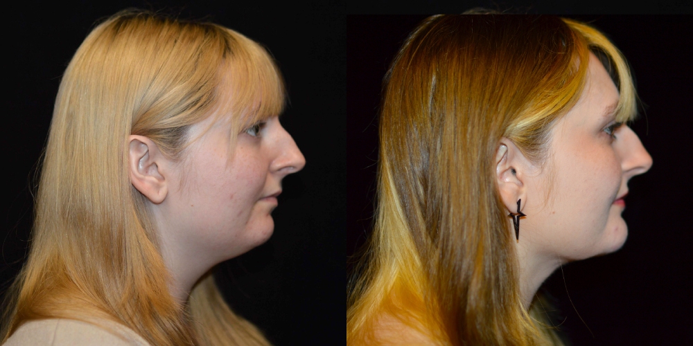 Neck Liposuction Before & After Patient #3611