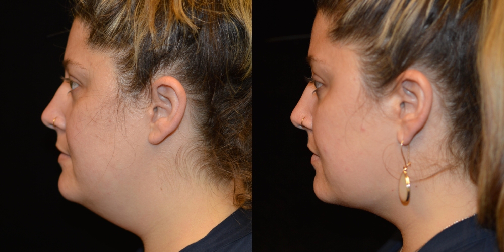 Neck Liposuction Before & After Patient #3606