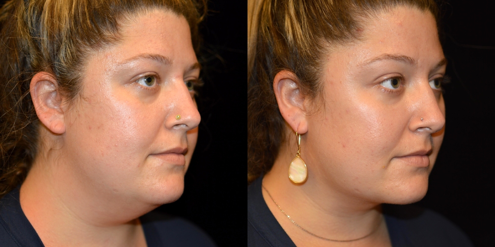 Neck Liposuction Before & After Patient #3606